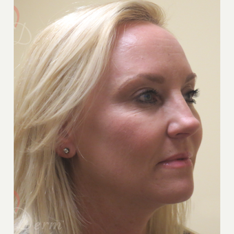 35-44 year old woman treated with Voluma in cheeks after 3368907