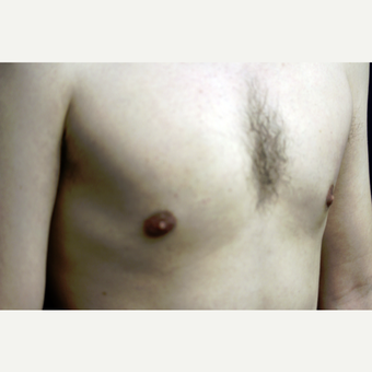 31 year old man treated for gynecomastia with liposuction after 3419136