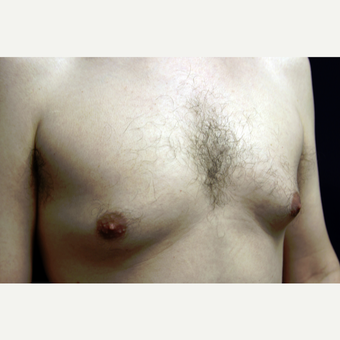 31 year old man treated for gynecomastia with liposuction before 3419136