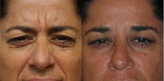 Dysport Glabella before 574819