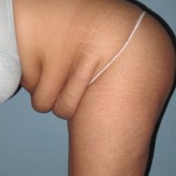 35-44 year old woman treated with Tummy Tuck before 3722168
