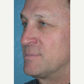 45-54 year old man treated with Rhinoplasty after 3732579