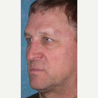 45-54 year old man treated with Rhinoplasty before 3732579
