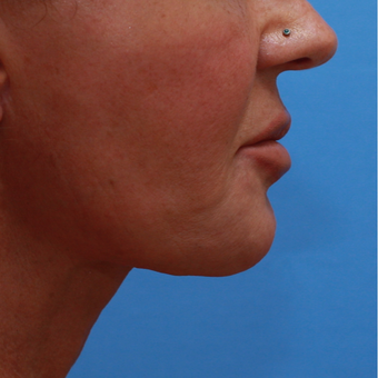 55-64 year old lady treated with Chin Implant after 3373023