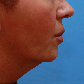 55-64 year old lady treated with Chin Implant before 3373023