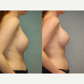 29 y/o Woman, 30 days post Correction of Inferior Implant Malposition after 3067251