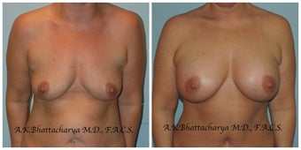 42 year old woman treated with Breast Augmentation before 3093900