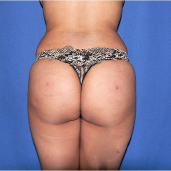 25-34 year old woman treated with Brazilian Butt Lift after 3002338
