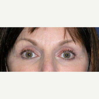 45-54 year old woman treated with Laser Resurfacing after 3467172