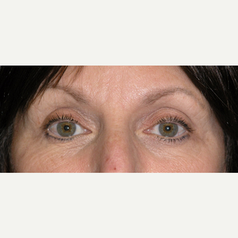 45-54 year old woman treated with Laser Resurfacing before 3467172