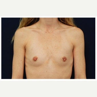 25-34 year old woman treated with Inspira Breast Implants before 1860175