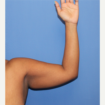 25-34 year old woman treated with Arm Lift before 3123345