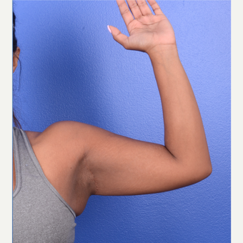 25-34 year old woman treated with Arm Lift after 3123345