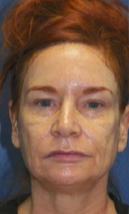 55-64 year old woman treated with CO2 Laser before 3033293