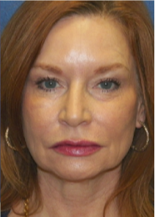 55-64 year old woman treated with CO2 Laser after 3033293