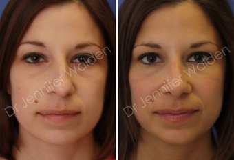Septorhinoplasty before 1112649