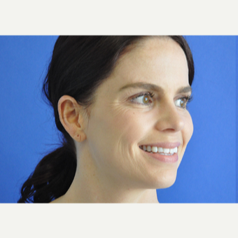 35-44 year old woman treated with Botox before 3214886