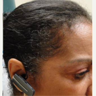45-54 year old african american female treated with PRP for Hair Loss after 3195546
