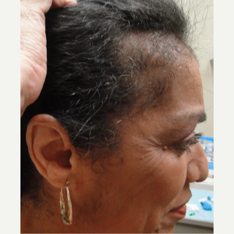 45-54 year old african american female treated with PRP for Hair Loss before 3195546