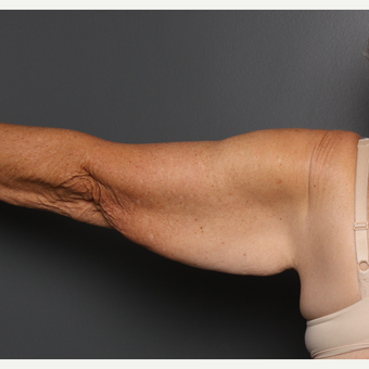 Arms before 3803384