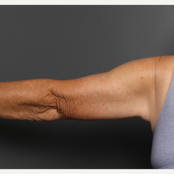 Arms after 3803384