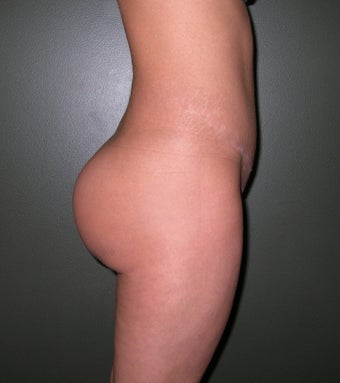 Buttock Augmentation with Implants after 1208131