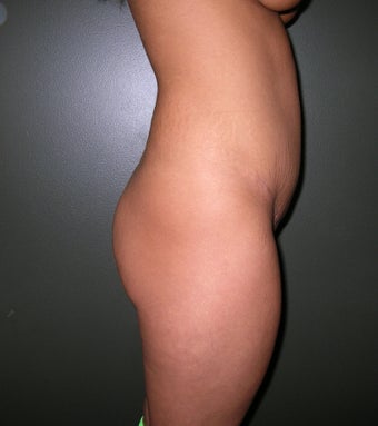 Buttock Augmentation with Implants before 1208131
