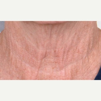 55-64 year old woman treated with CO2 Laser before 1746858