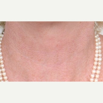 55-64 year old woman treated with CO2 Laser after 1746858