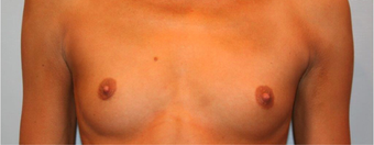 25-34 year old woman treated with Breast Augmentation before 3319061