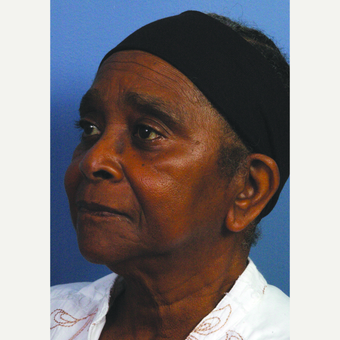 65-74 year old woman treated with Facelift before 3453897