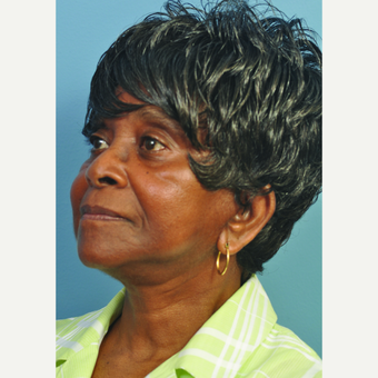 65-74 year old woman treated with Facelift after 3453897