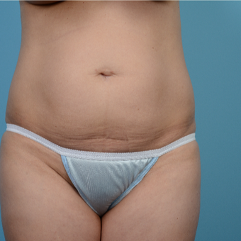 35-44 year old woman treated with Tummy Tuck before 3089262