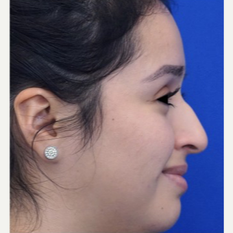 25-34 year old woman treated with Non Surgical Nose Job before 3711512