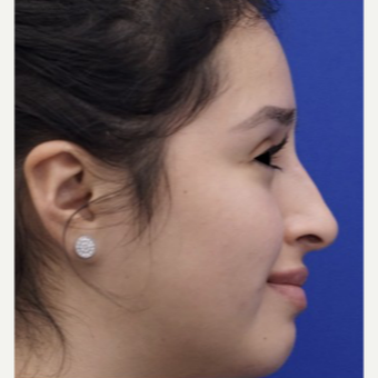 25-34 year old woman treated with Non Surgical Nose Job after 3711512