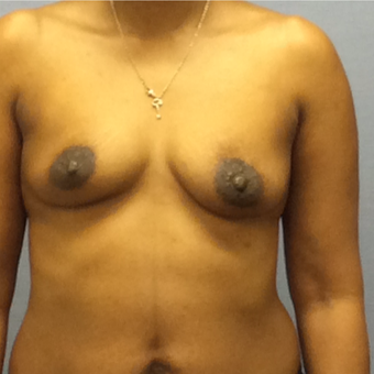 35-44 year old woman treated with Breast Augmentation before 3147547