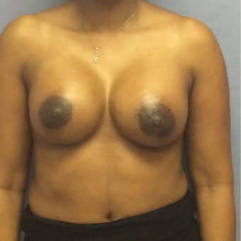 35-44 year old woman treated with Breast Augmentation after 3147547