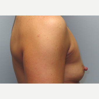 35-44 year old woman treated with Breast Augmentation before 3185769