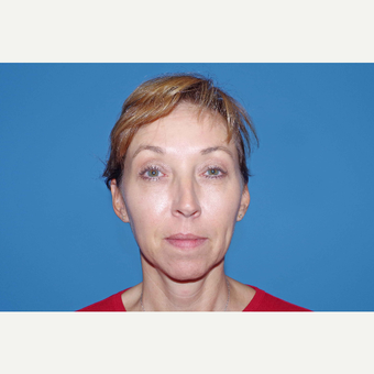 45-54 year old woman treated with ArteFill after 3630158