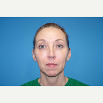 45-54 year old woman treated with ArteFill before 3630158