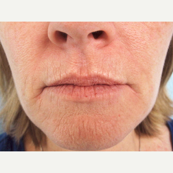 Dermabrasion before 3814096