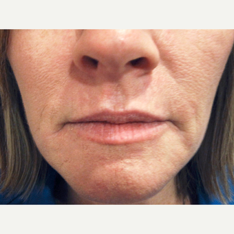 Dermabrasion after 3814096