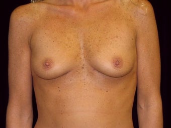 Breast augmentation before 293898