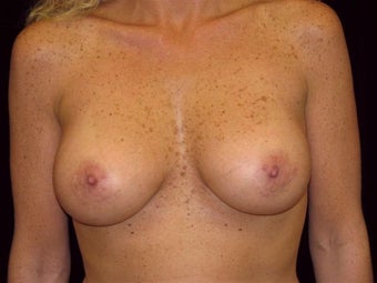 Breast augmentation after 293898