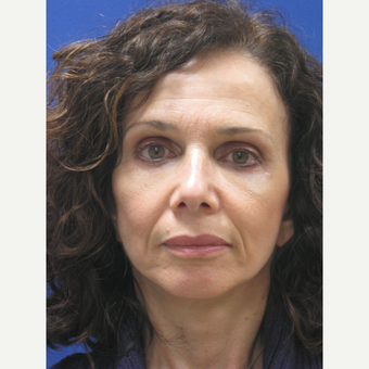 45-54 year old woman treated with Lifestyle Lift after 3802430