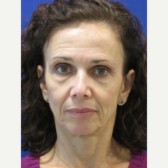 45-54 year old woman treated with Lifestyle Lift before 3802430