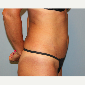 35-44 year old woman treated with Tummy Tuck before 3815724