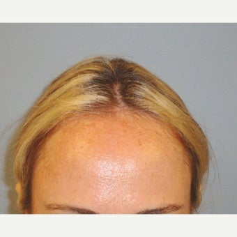 32-year-old woman 8 months after 1878 grafts before 1957058