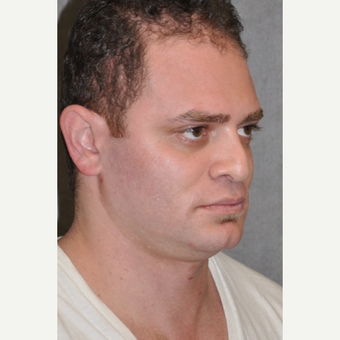 25-34 year old man treated with Rhinoplasty before 3566504