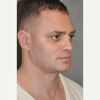 25-34 year old man treated with Rhinoplasty after 3566504